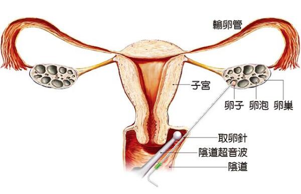 不孕症