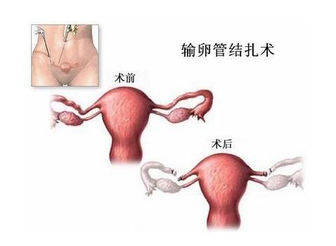 个人 代孕
