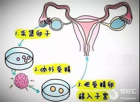 东莞试管婴儿